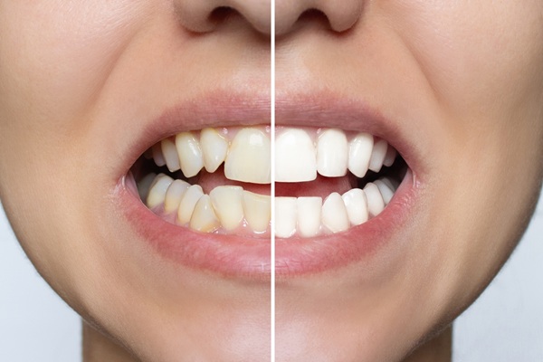 Teeth Whitening Aftercare: How To Keep Your Smile Bright