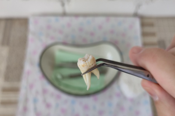 How To Recover From A Wisdom Tooth Extraction